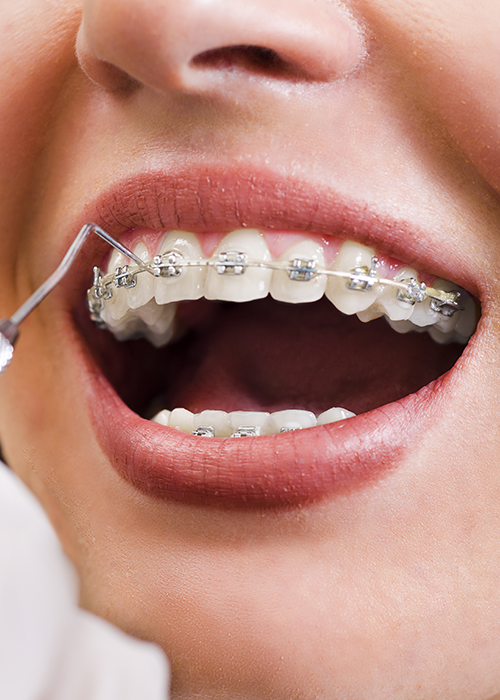 A close-up smile with braces.